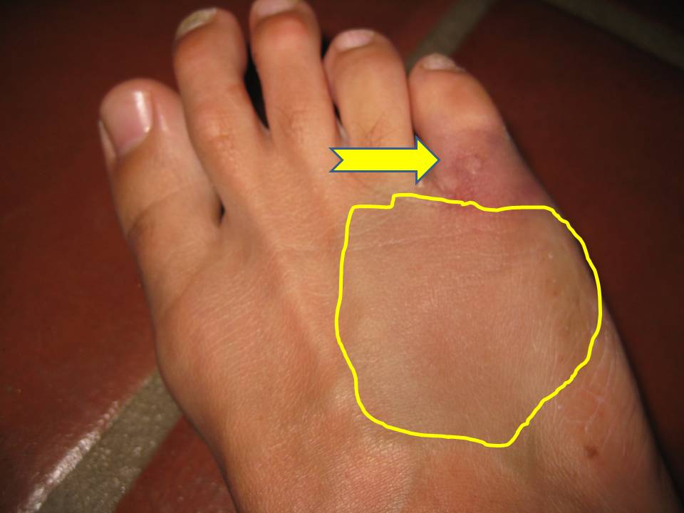 what-does-a-broken-pinky-toe-look-like-but-it-s-only-a-broken-toe-a