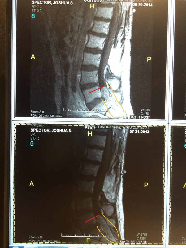 Spinal Tumor Ependymoma MRI